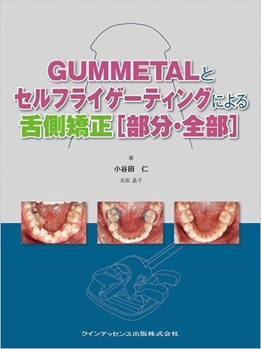 GUMMETALとセルフライゲーティングによる舌側矯正(部分·全部)